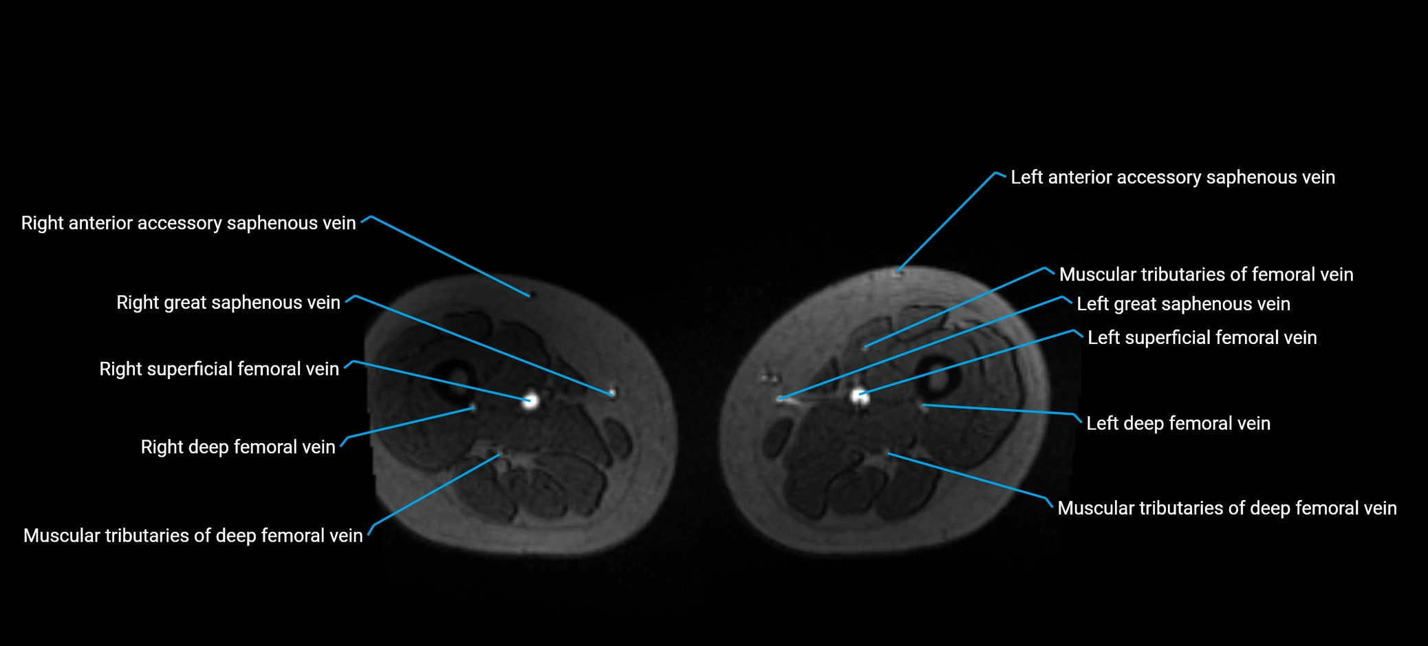 MRV abdomen pelvis & lower limb axial cross sectional anatomy labelled MRI image 282 (1).webp
